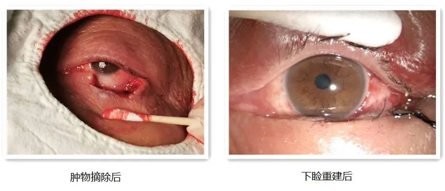 眼皮里长了个小疙瘩是癌吗,下眼睑长了白色凸起小块会是癌吗