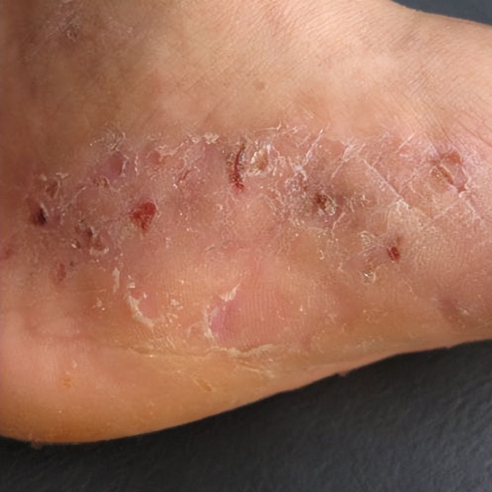 水上乐园感染红眼病,有妇科病能去水上乐园玩吗