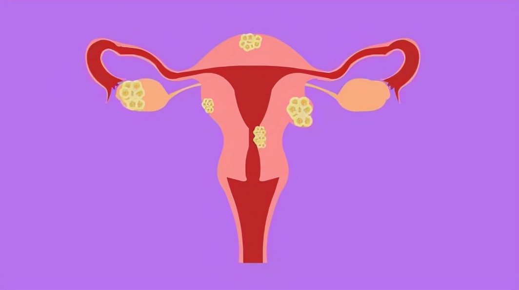 桔子可以治疗子宫肌瘤吗,子宫肌瘤可以吃橘子吗