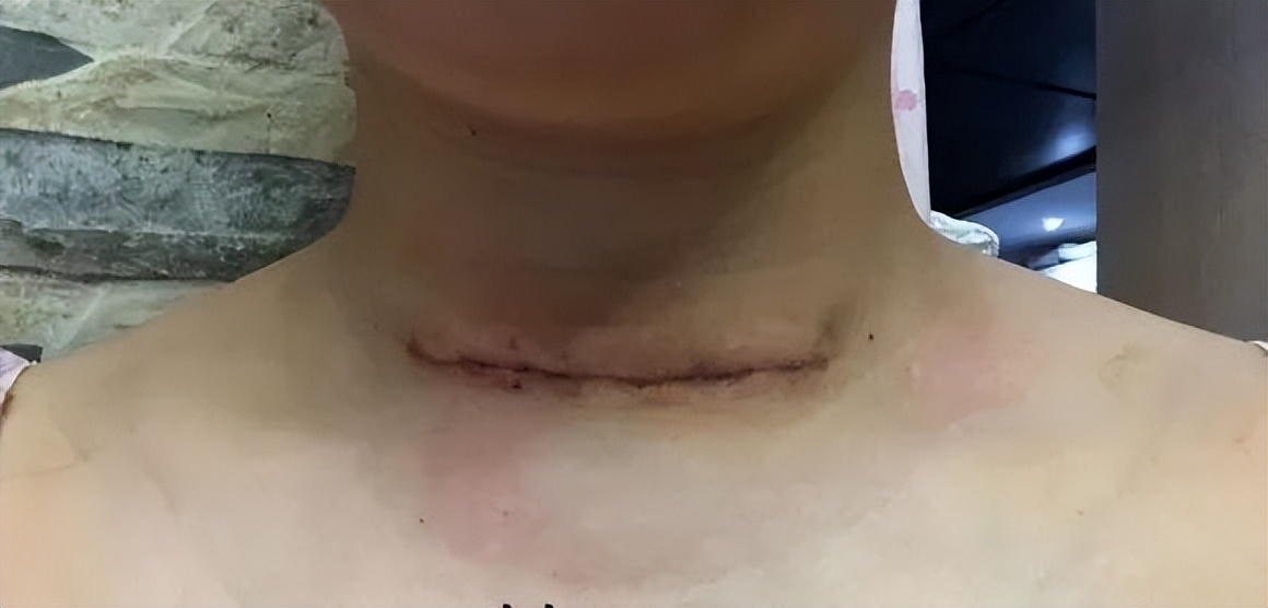 结节消融后就完全康复了吗,结节消除中成药