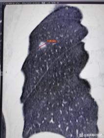 “就信戴主任，火速做完手术”，肺磨玻璃结节妹子术后还愿贴