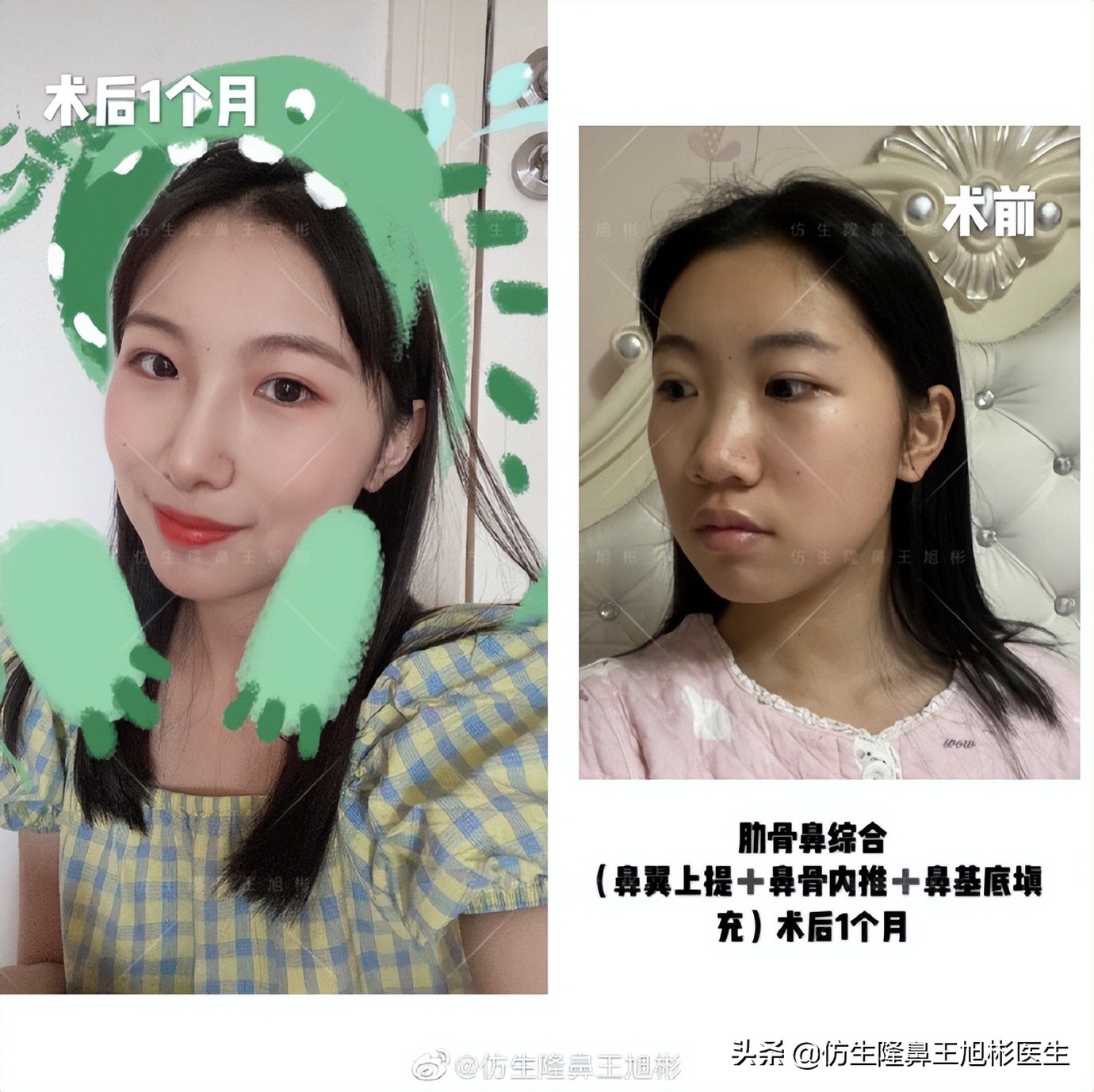 做一次鼻头缩小要多少钱好,可以只做鼻头缩鼻翼吗