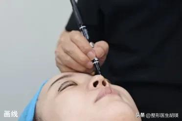 双眼皮术后20天基本不再变化了,挑战双眼皮术后39天做睫毛