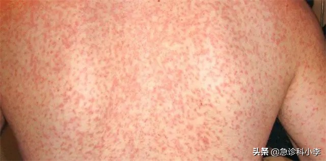 孩子身上小红点不痛不痒是什么病,身上起小红点不痛不痒按压会消失