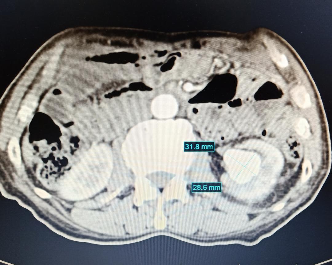 门医技术|区医院肿瘤与介入科成功解除藏在患者体中的“定时*弹炸**”——动脉瘤