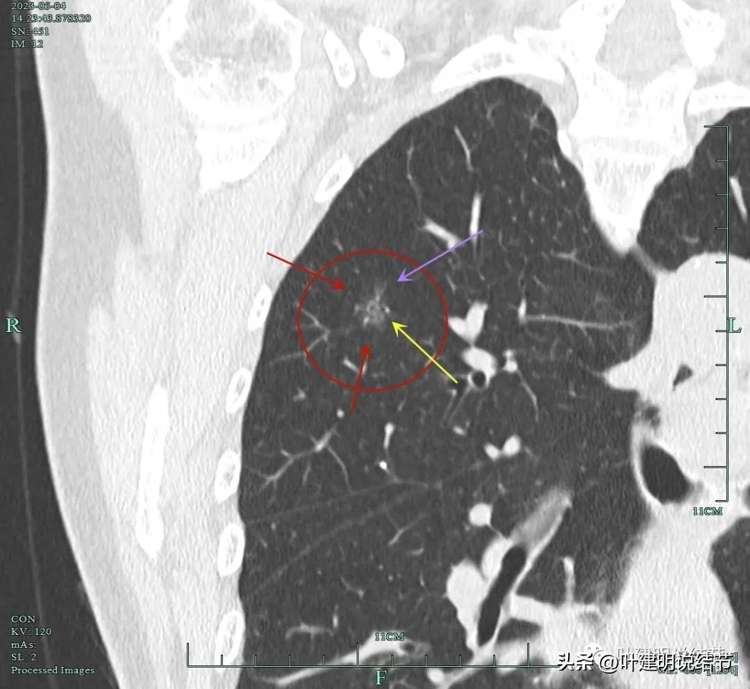 肺楔形切除肺功能降低,肺楔形切除需要缝合吗