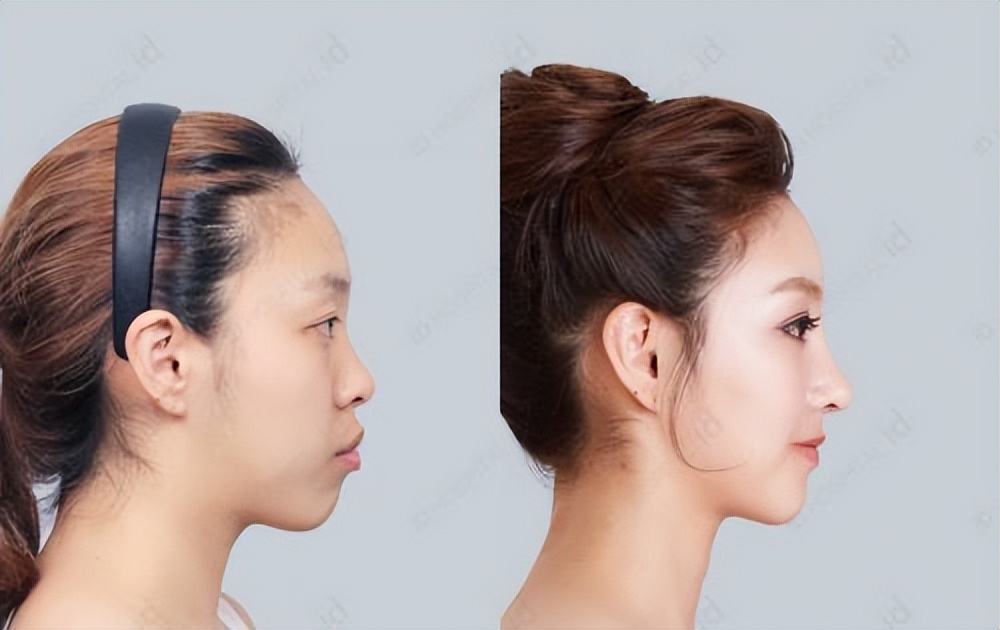 比法令纹更靠上的纹,嘴凸有法令纹改善对比