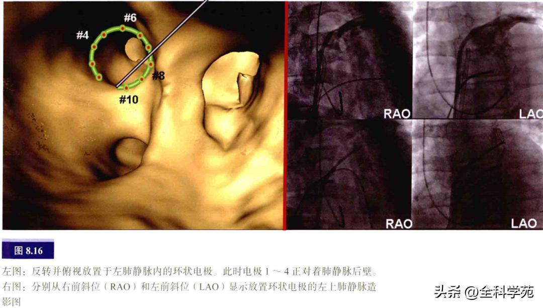 连接左心房的是肺静脉吗,左心房与肺静脉解剖