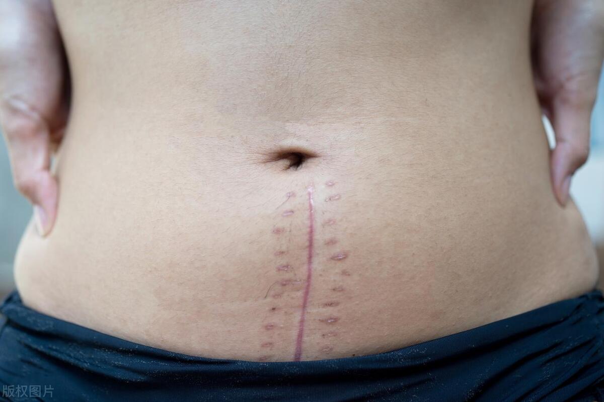 女朋友宫颈癌要分手吗,宫颈癌切除5年了