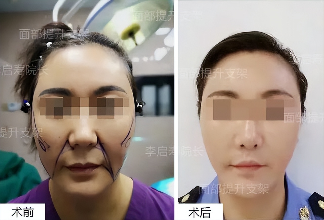 面部提升整形失败如何修复,面部提升年轻化术真实案例