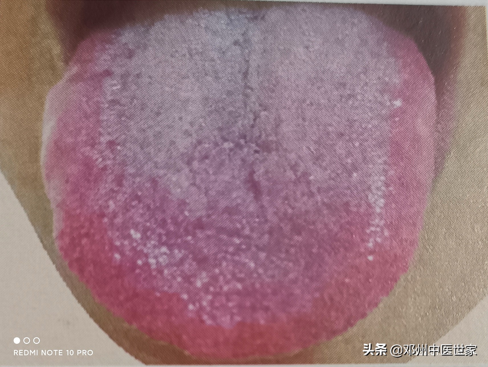 胃痛湿热中阻的方子,湿热中阻型胃痛方剂