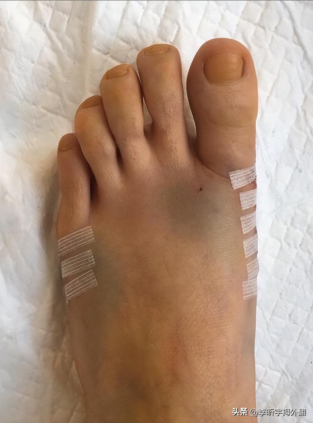 拇外翻术后骨头愈合强度,拇外翻术后伤口开裂