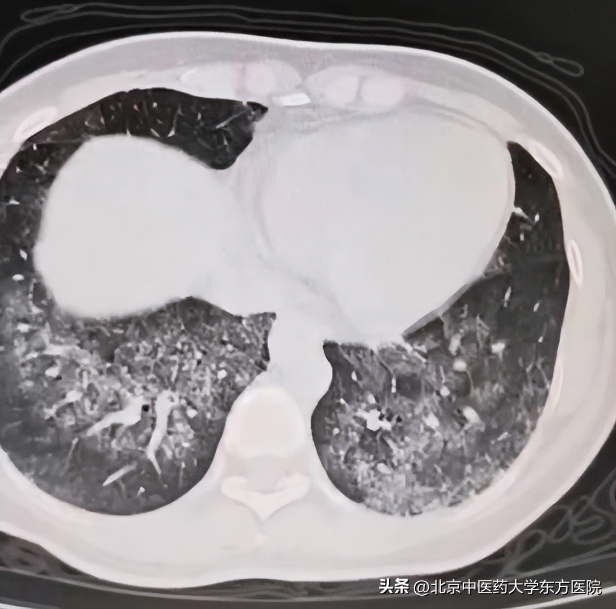 咳嗽痰中带血不可小视可能隐藏着大疾患