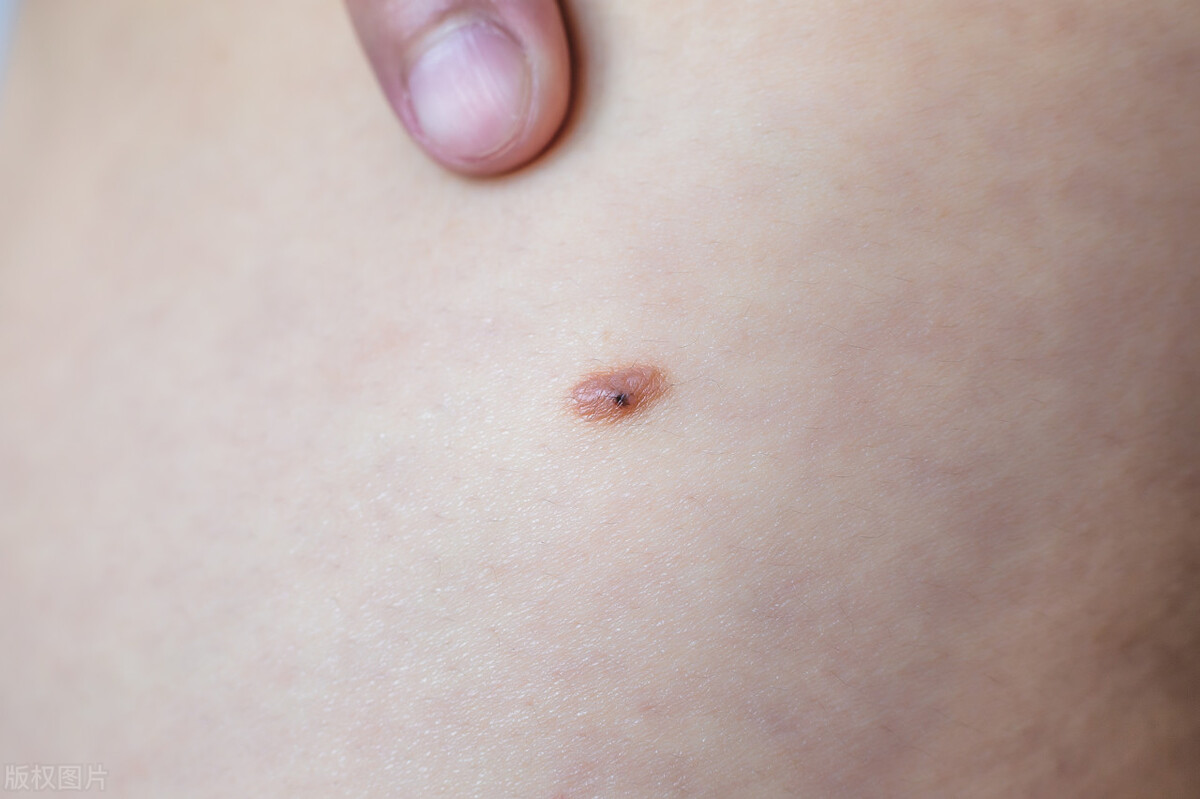 哪些部位有痣是癌症的预兆,蜘蛛痣长在哪里是癌症的表现