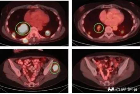 抗癌新突破特效药,突破精准抗癌药