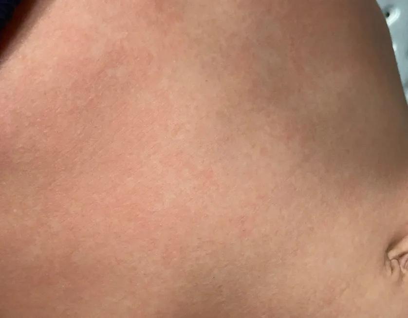 儿童发热后有红点是怎么回事,儿童发热后身上起红疹子