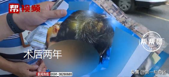 花三万多元植发反被拉低颜值,花一万多块钱植发值不值