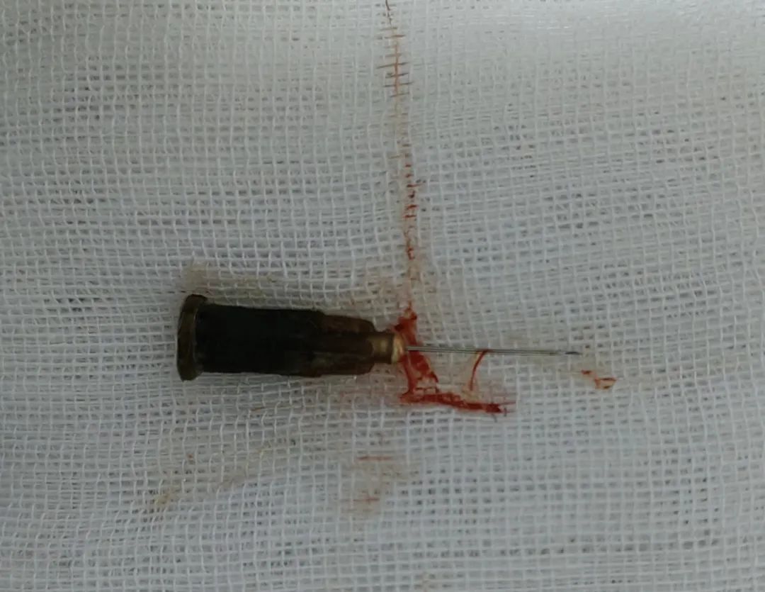 西安市北方医院:患者支气管里发现注射器针头，医生巧施异物钳顺利取出