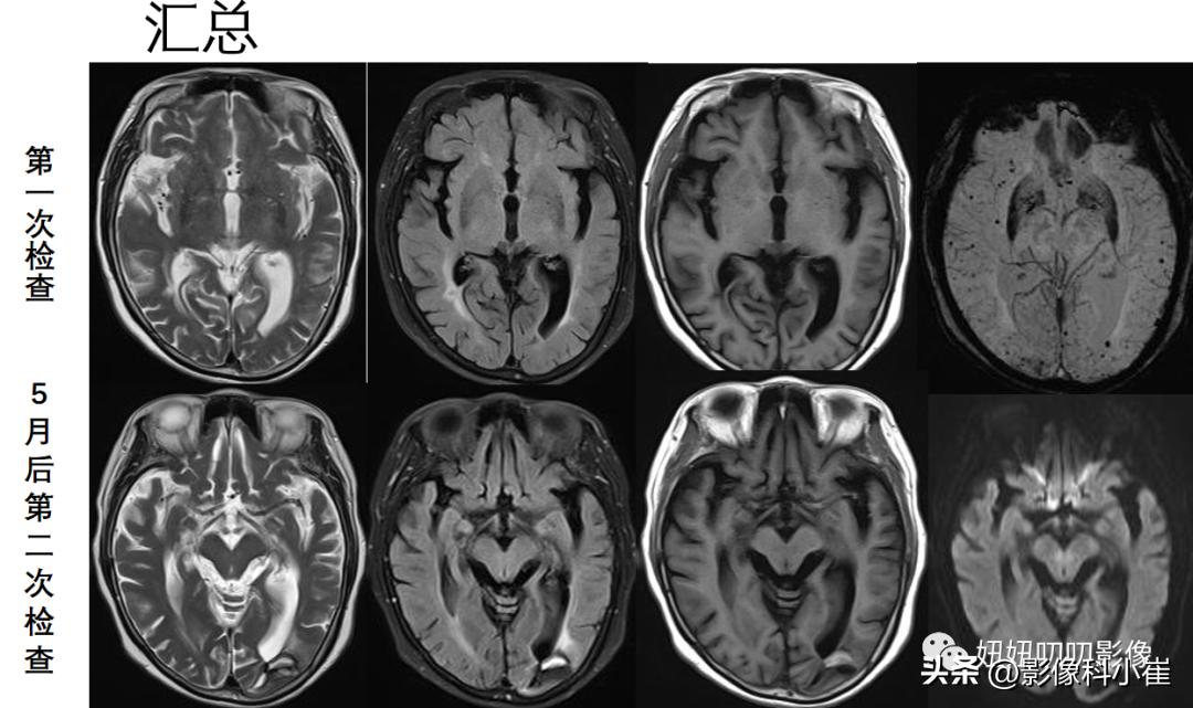 脑部肿瘤疾病有哪些,脑部有病变但是不是肿瘤