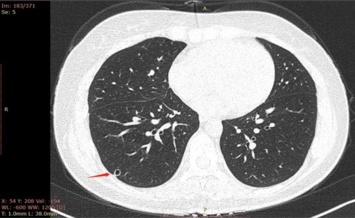 磨玻璃结节9*8mm建议随访,8mm磨玻璃结节一年没长