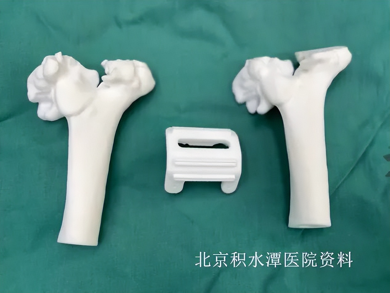 患者是我们最好的老师，也是我们创新的动力——北京积水潭医院蒋协远教授团队完成第二例肘关节表面置换手术