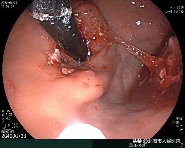 消化内科胃底静脉曲张治疗,消化内科静脉曲张手术费用