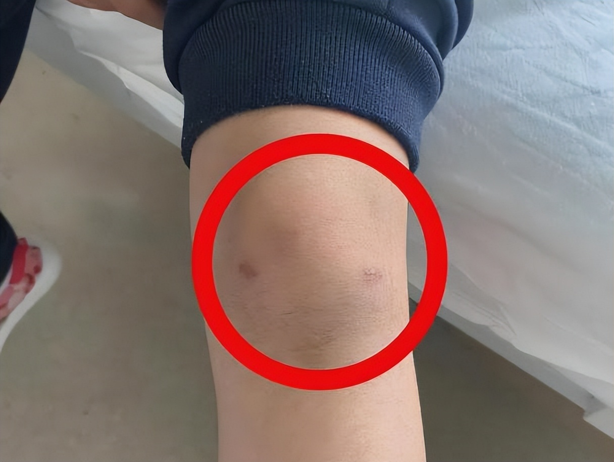 腿窝旁边起了一个鼓包是积液吗,腿左侧腘窝囊肿怎么治疗