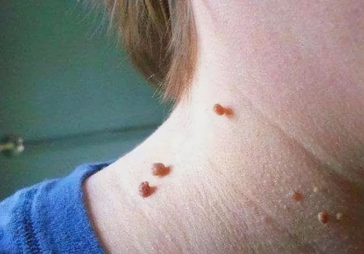 脖子腋下长小肉粒什么原因引起的,脖子上和腋下长小肉粒是什么原因