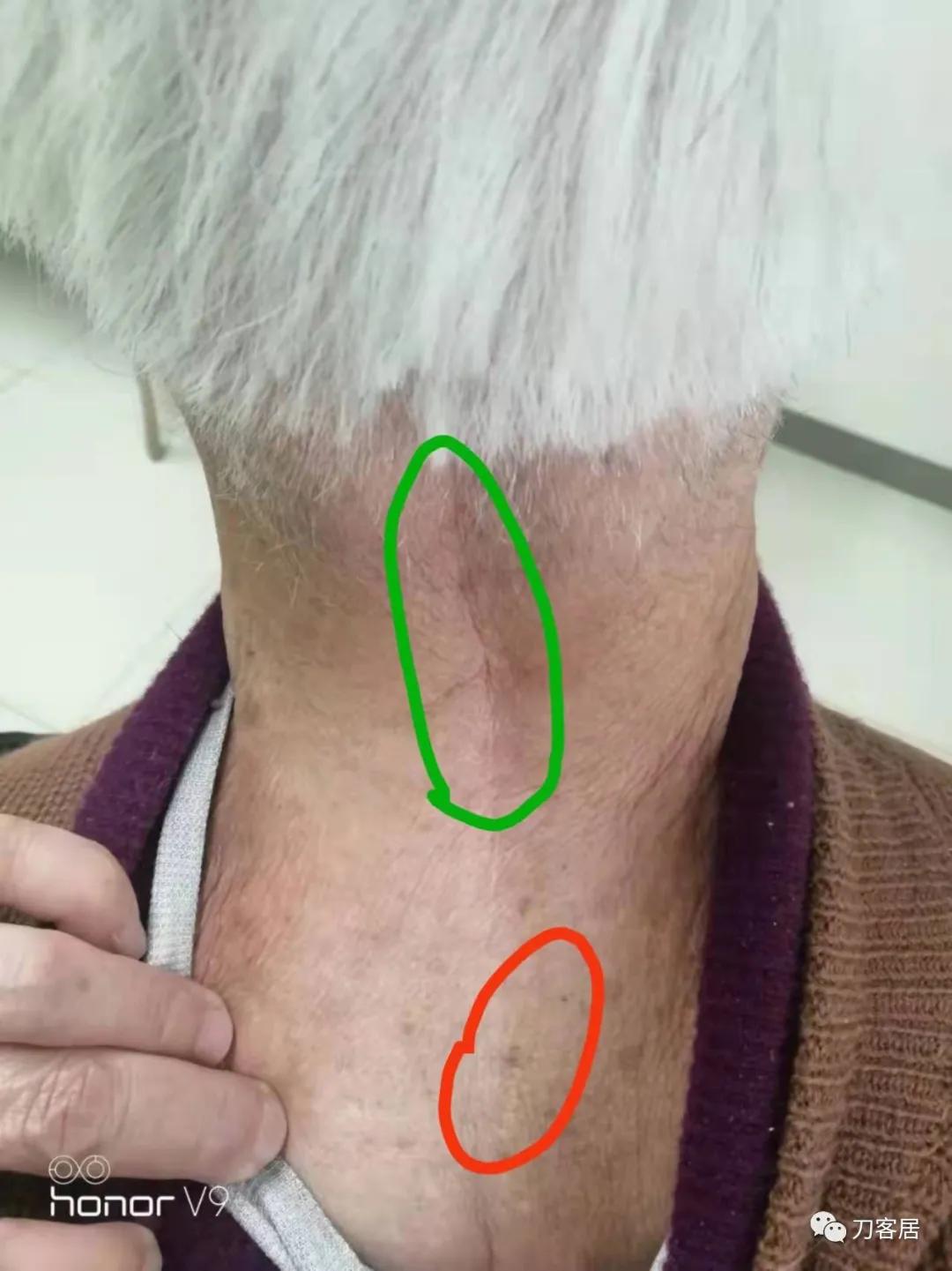 颈椎椎管内肿瘤手术20例麻醉处理,颈椎脊髓内肿瘤手术成功案例