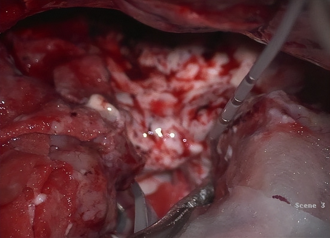 癫痫病灶可能有几个,癫痫频发