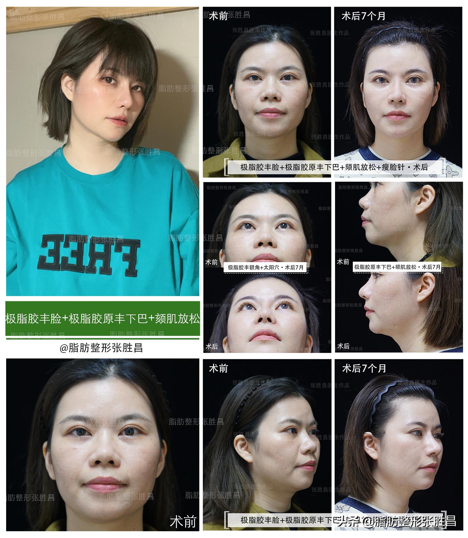 脂肪填充的真相,你不可不知道的面部脂肪填充真相