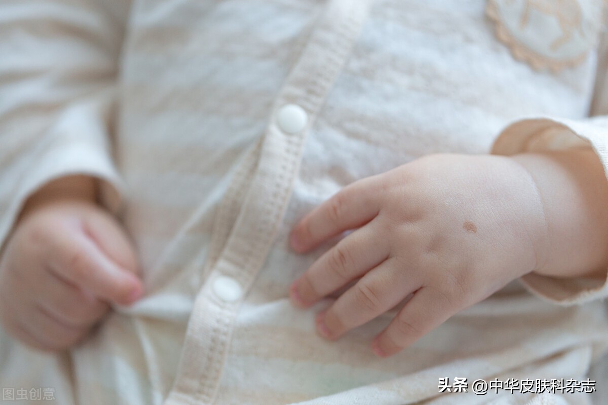 身上长咖啡色斑图片,孩子身上有咖啡色的斑是什么原因