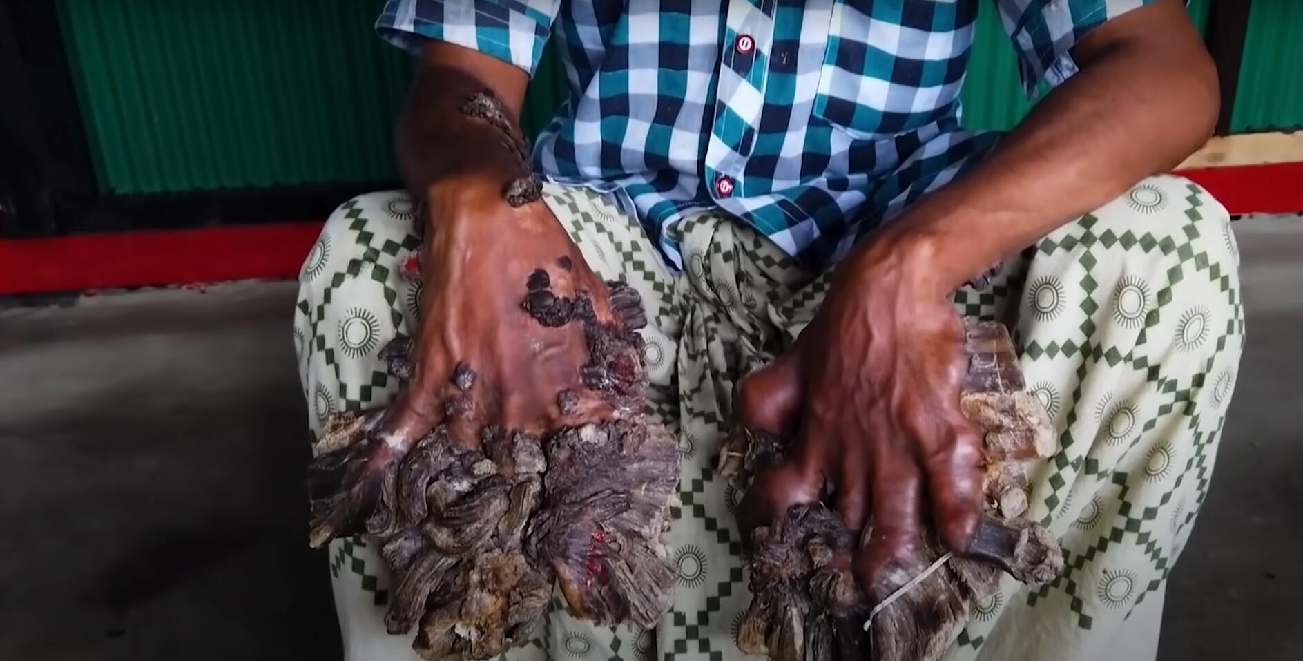 10个难以置信的人类，树皮人、外星人、拥有粗壮手臂的大力水手