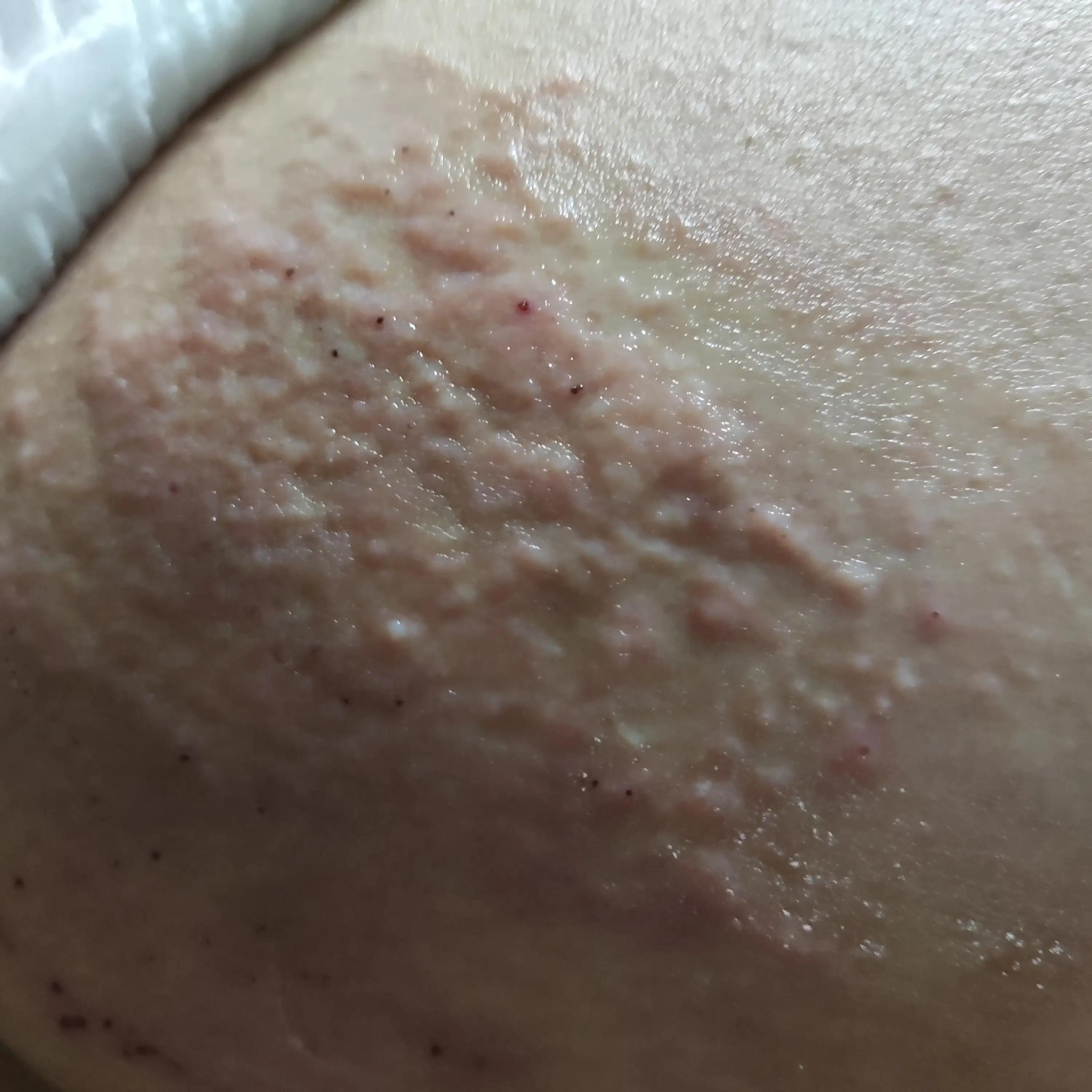 风疹不治疗可以自愈吗,风疹病毒治疗多少钱