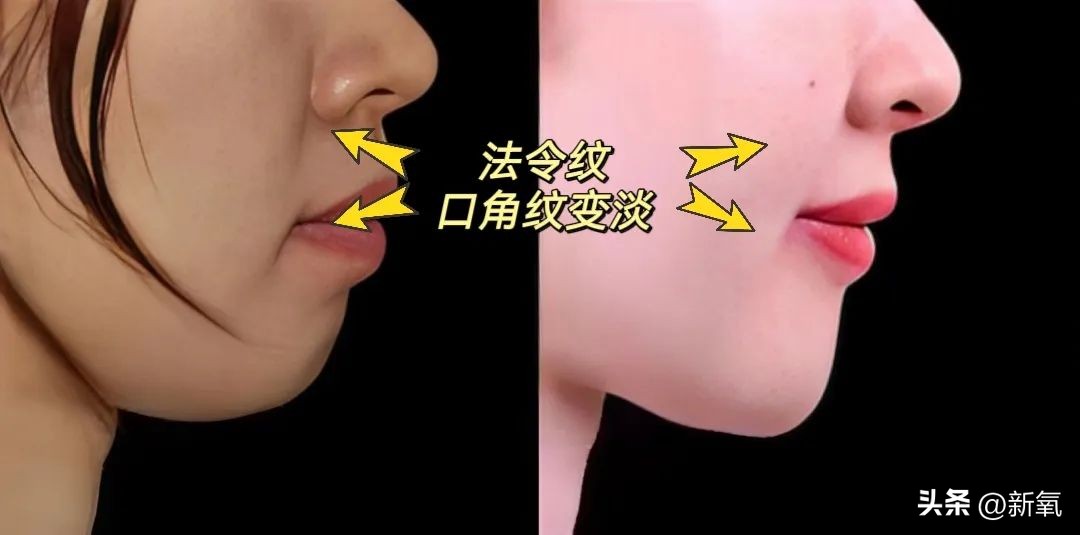 牙齿正畸和骨骼正畸的区别,牙齿正畸和眼轴增长有关系吗