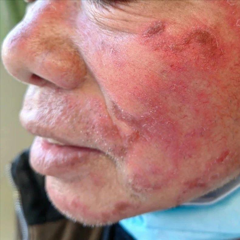 面部皮炎的症状和治疗方法,面部皮炎是怎么回事