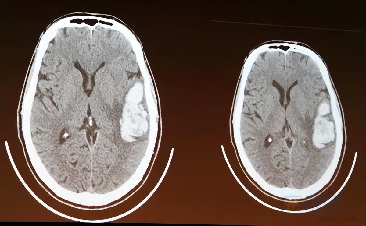 脑出血诊断后，如何处理？