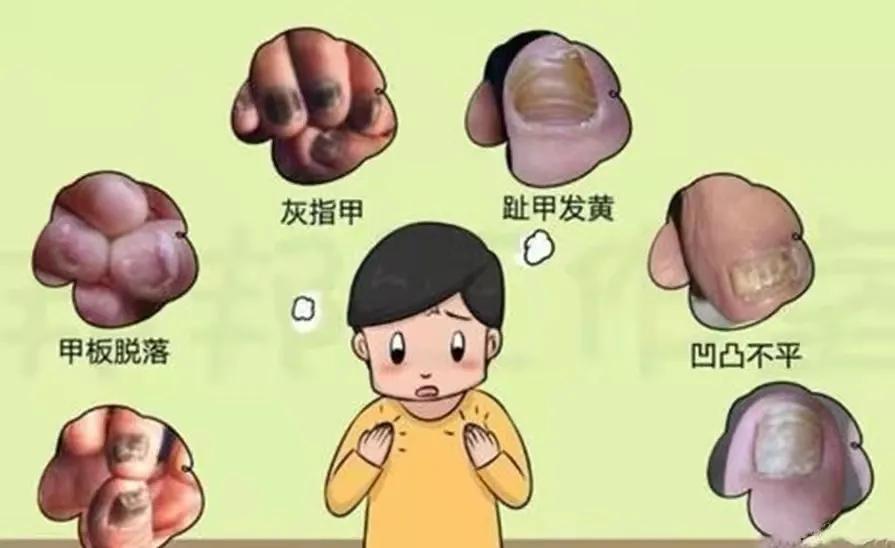 灰指甲在医院看哪个科,甲沟炎灰指甲在医院挂什么科