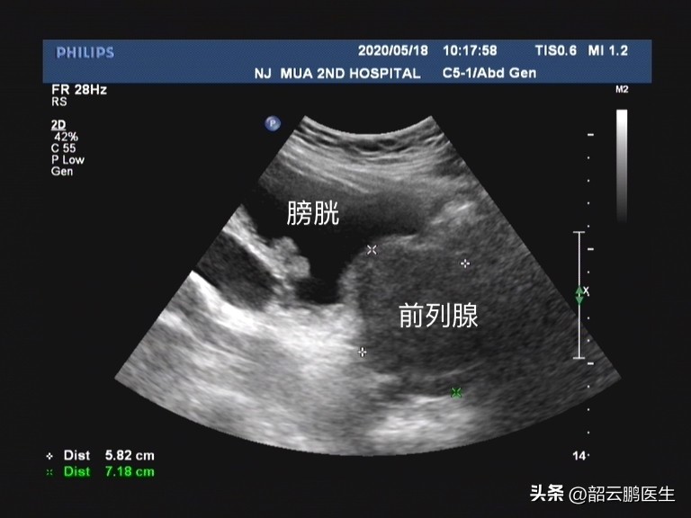 前列腺增生夜尿多吃什么中成药好,前列腺增生小腹胀痛吃什么中成药