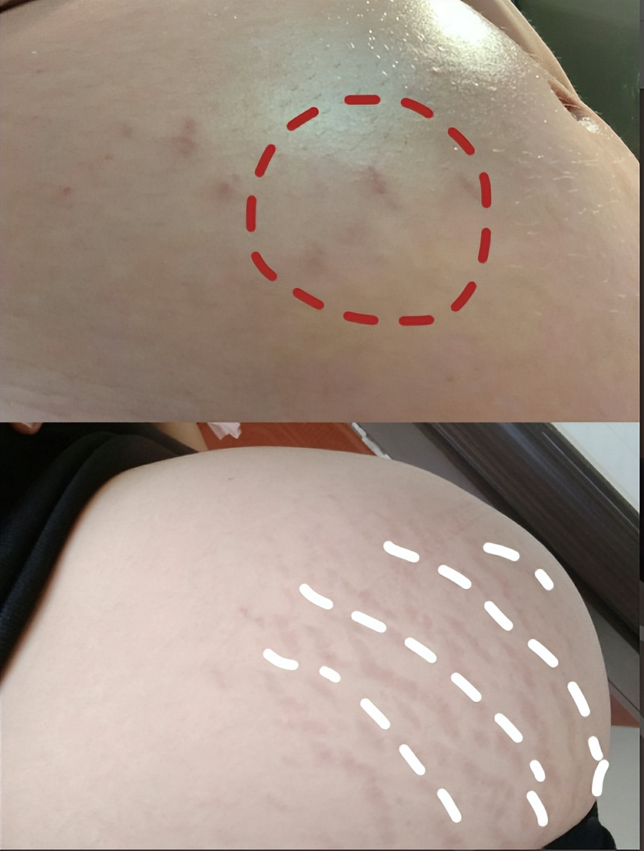 涂妊娠油真的可以不长妊娠纹吗,哪种妊娠纹油好用