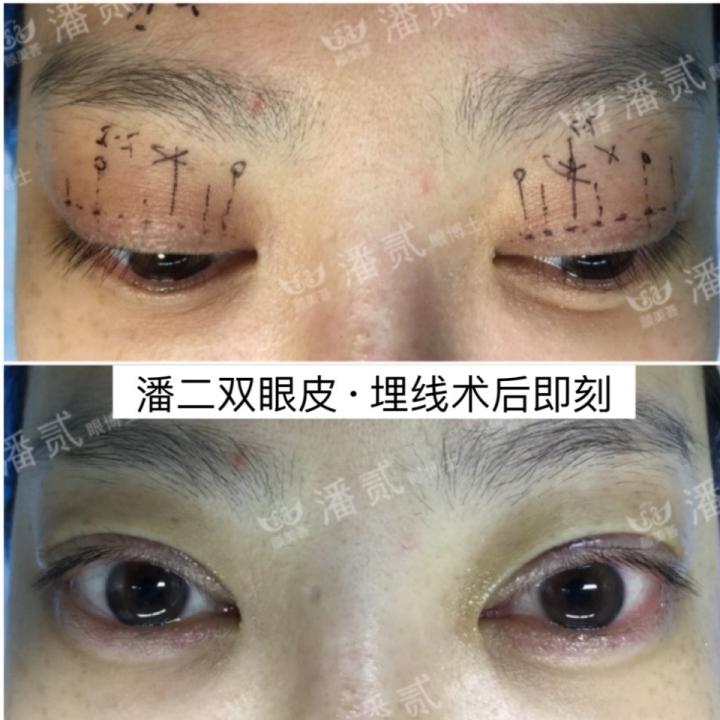 凸眼球显得眼睛大,凸眼眼窝凹陷