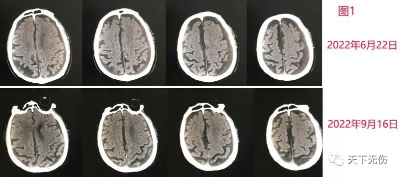 颈部淋巴结血肿,90多岁老人硬膜下血肿引流手术