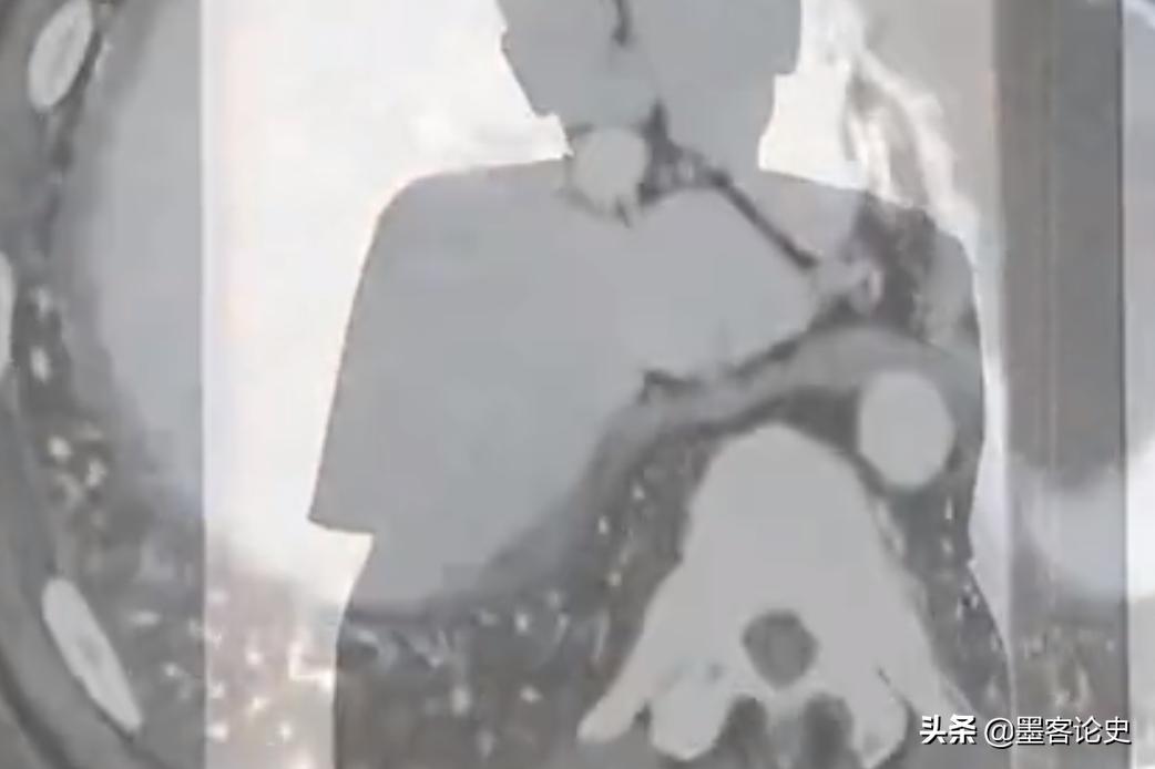 癌症晚期内蒙古小伙,53岁大叔肝肿瘤