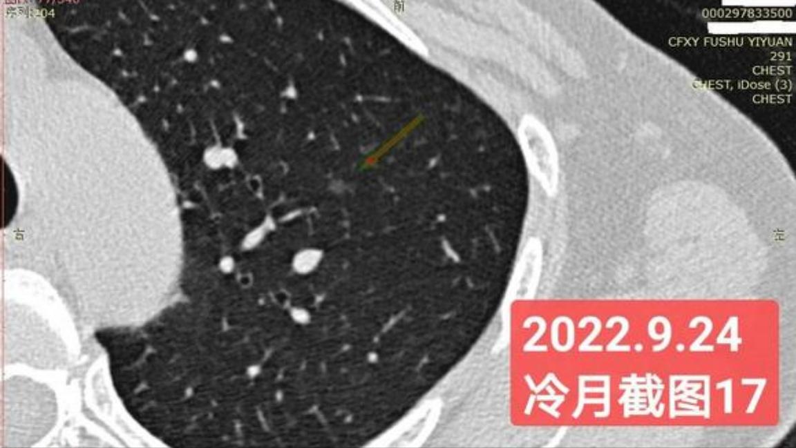 7mm肺结节恶性的怎么办,7mm实性肺结节危险程度
