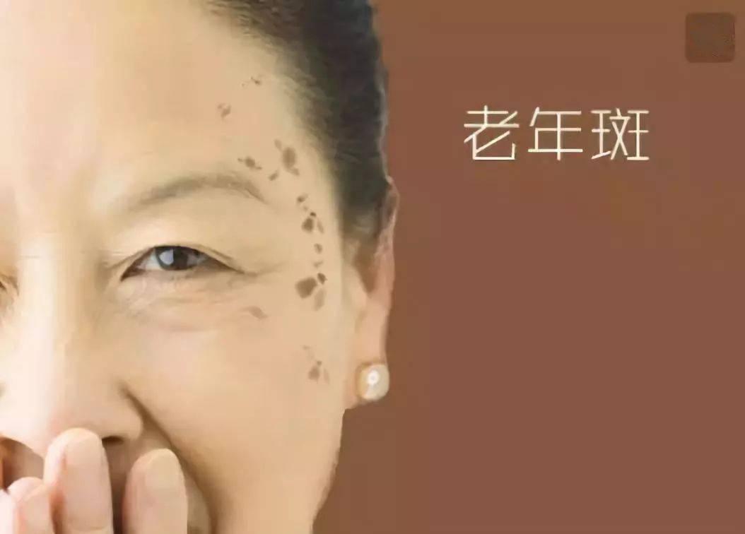 老年斑用红霉素软膏可以除掉吗,用红霉素眼药膏去除老年斑有效吗
