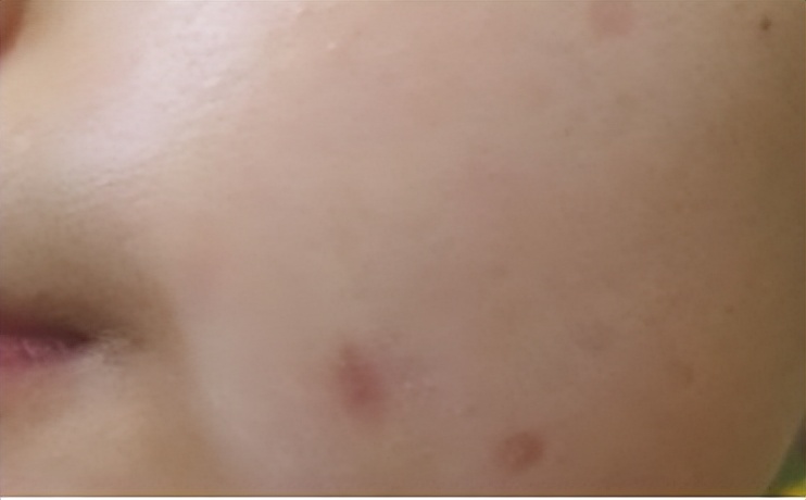 人各有“痣”，长在这些部位的痣易癌变！ABCDE法自测危险程度