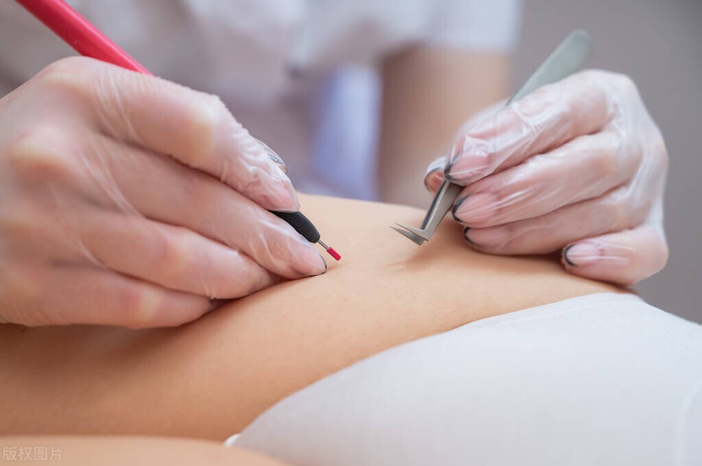 男子腹部痒，医生用镊子夹出16只阴虱！医生：阴虱有2个传播途径