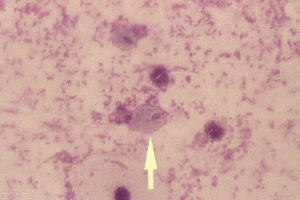 牙痛“神药”甲硝唑，对这4种疾病效果很好，不妨了解一下