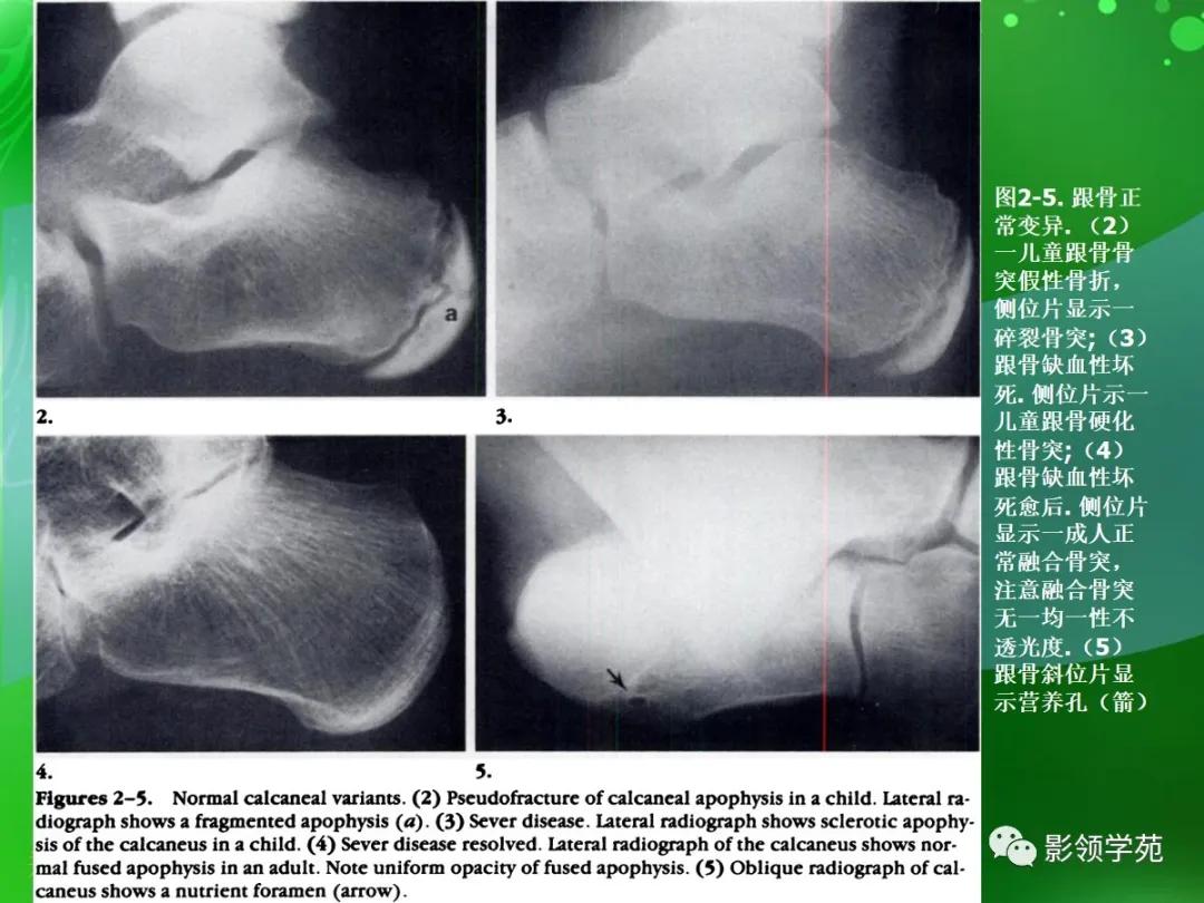 正常跟骨影像图,跟骨正常与变异影像表现图片