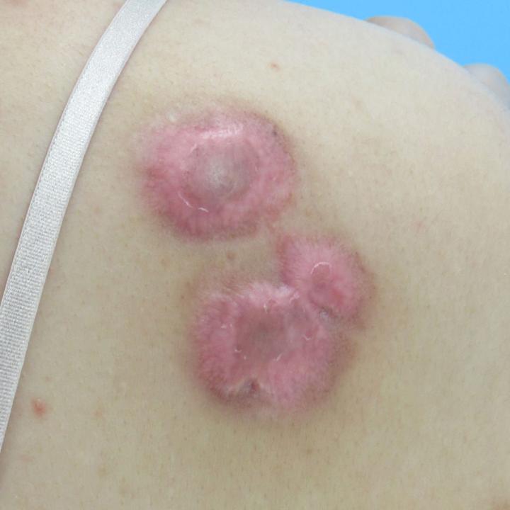 疤痕疙瘩该如何治疗？疤痕疙瘩治疗方法有哪些？